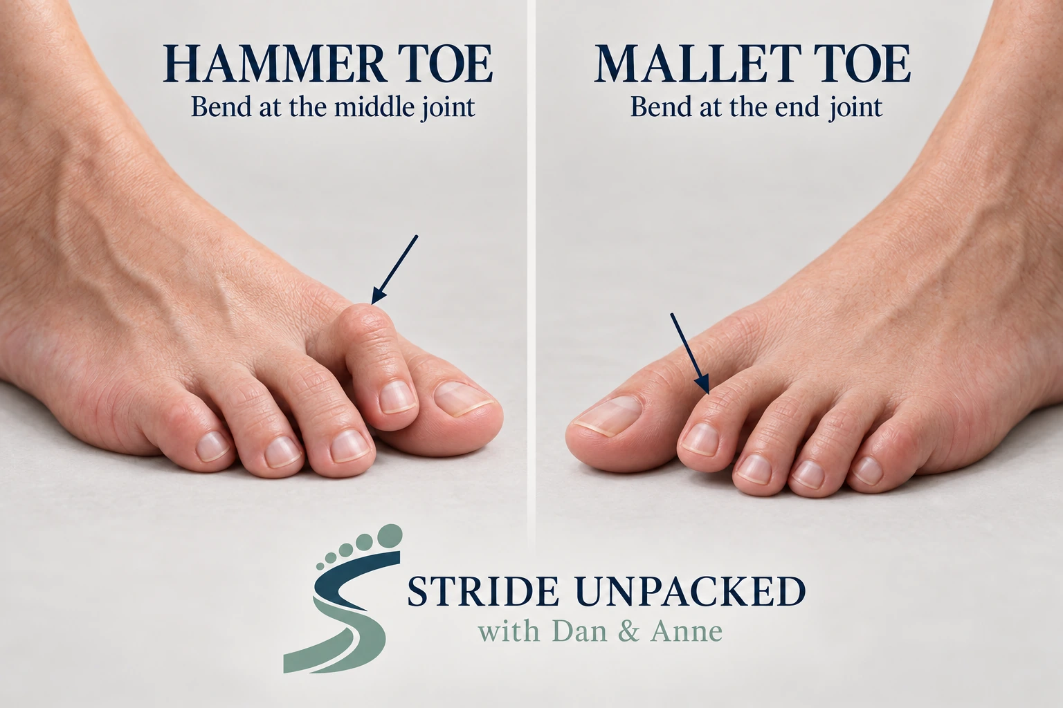 Photorealistic educational illustration of a left foot with a hammer toe and a right foot with a mallet toe, with labelled arrows and Stride Unpacked branding.