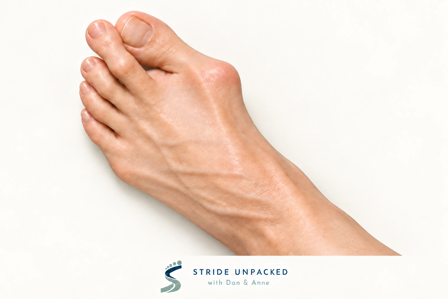 Photorealistic educational illustration of a bunion with the big toe angled towards an elevated second toe, with Stride Unpacked branding.