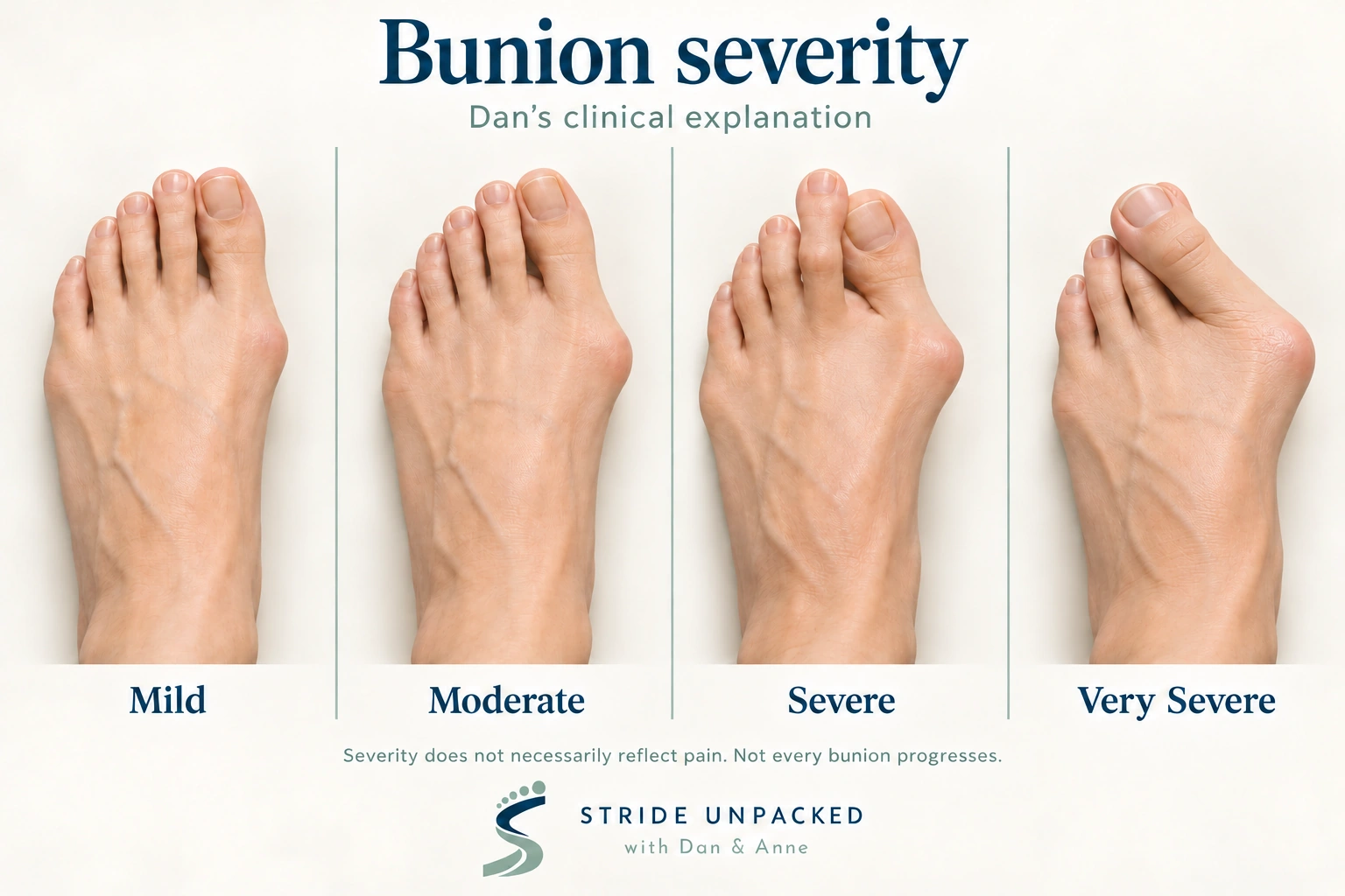 Illustrative comparison of mild, moderate, severe and very severe bunion appearances using Dan’s clinical explanation, with Stride Unpacked branding.